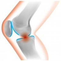 腸脛靭帯炎による膝の炎症